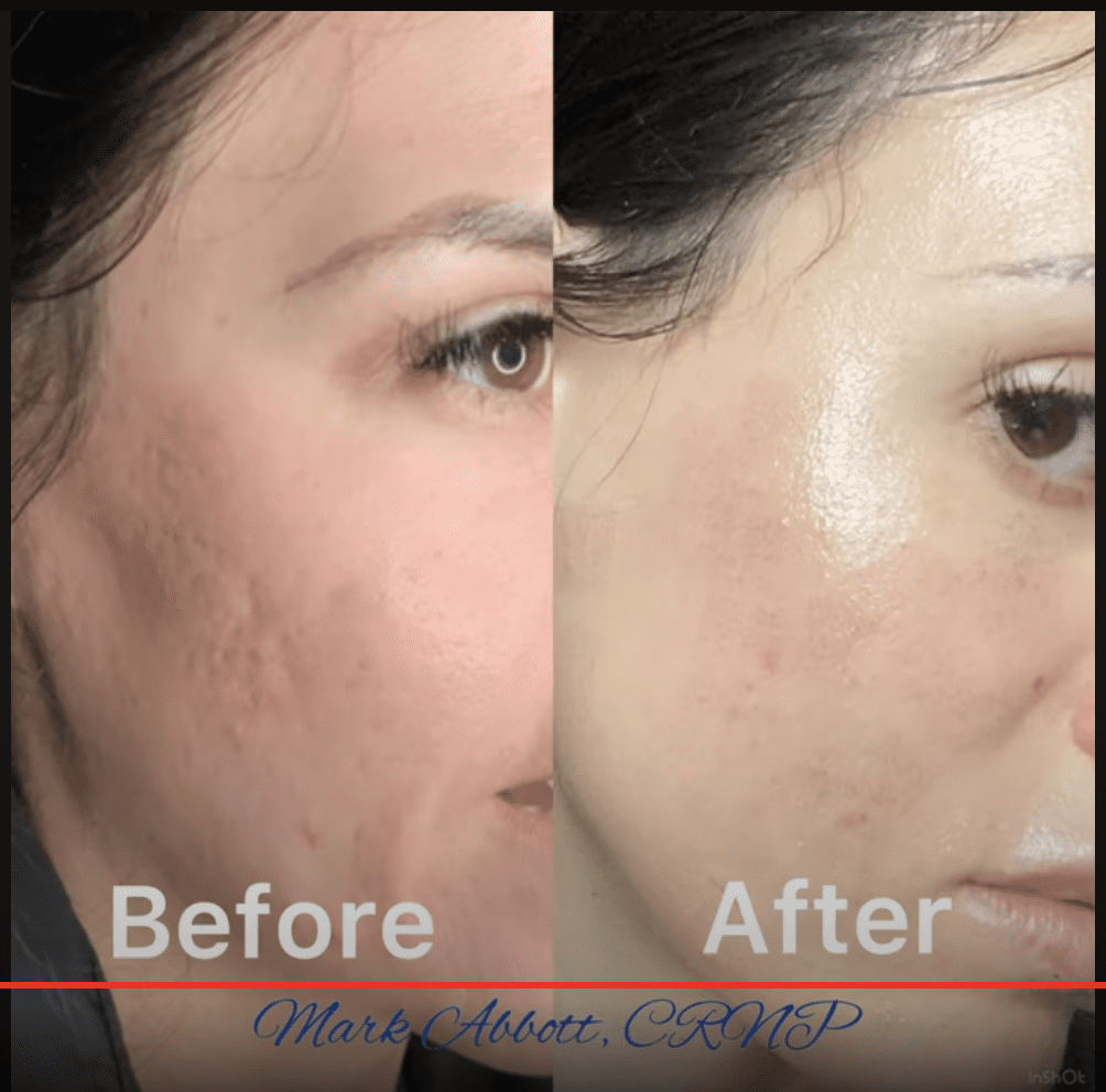 cool peel before and after